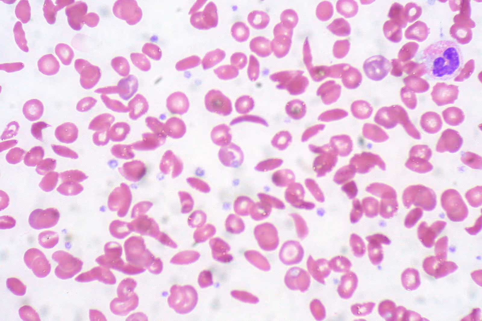 Esfregaço de sangue periférico mostrando hemácias em forma de foice características da anemia falciforme ao lado de hemácias normais