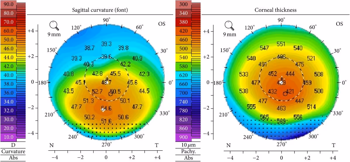 Topografia corneana mostrando ceratocone estágio II no olho esquerdo