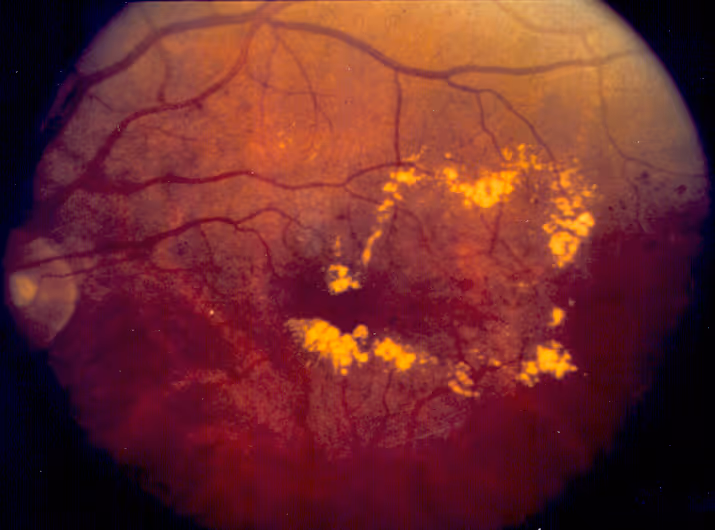 Retinografia mostrando edema macular diabético com exsudatos amarelos na mácula