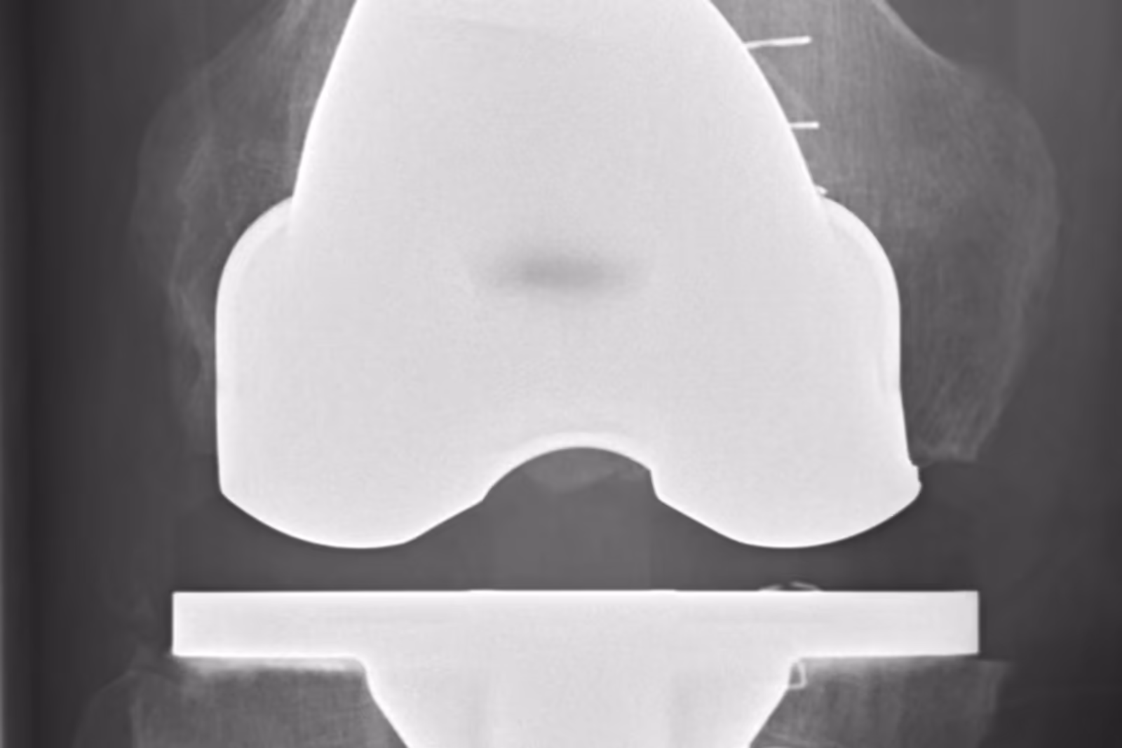 Radiografia de frente de um joelho após colocação de prótese total